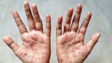 Indonesia xem xét điều trị miễn phí cho bệnh nhân mắc đậu mùa khỉ