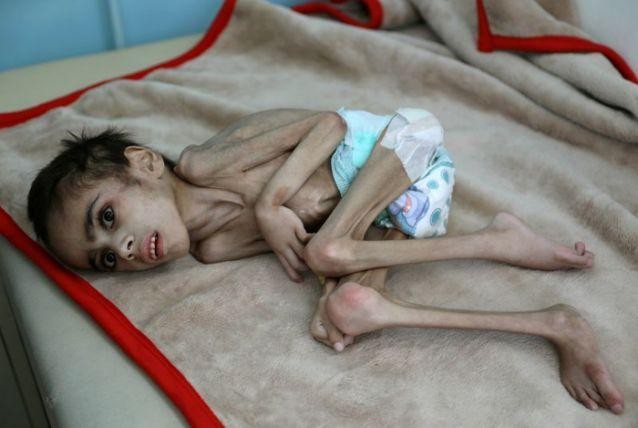 Bé trai Yemen suy dinh dưỡng nặng 7 cân