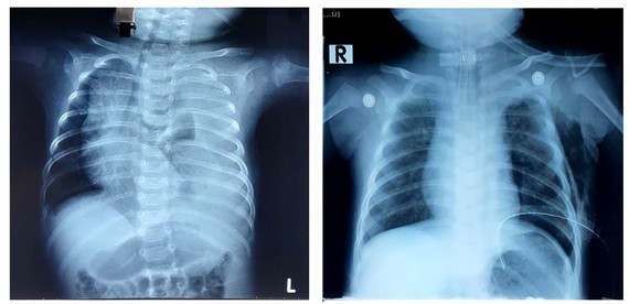 Hình ảnh chụp X-quang của bé trai sau ca phẫu thuật thành công bằng phương pháp thắt ống ngực.