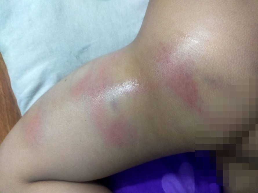 Hình ảnh chân bé gái 4 tuổi bị bầm tím. Ảnh: TTXVN