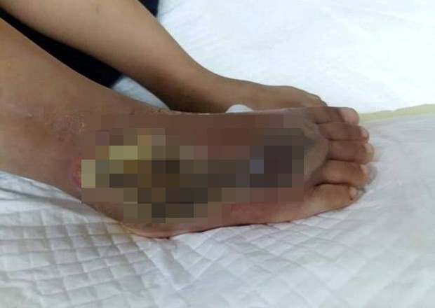 Do không được cứu chữa kịp thời, một phần bàn chân của bé gái đã bị hoại tử. Ảnh: Infonet