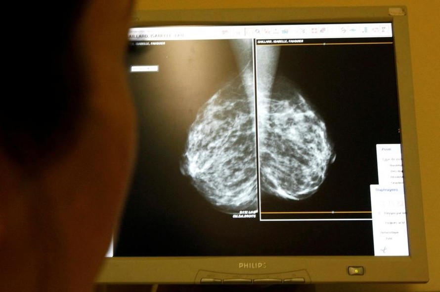 Công nghệ AI giúp nhanh chóng phát hiện ung thư vú 