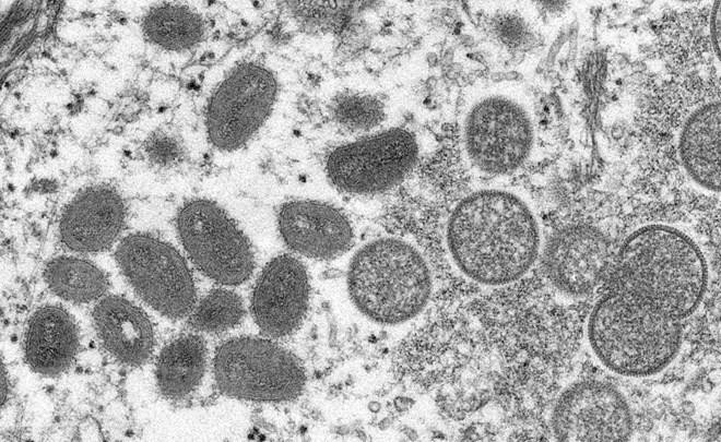 Hình ảnh dưới kính hiển vi cho thấy virus đậu mùa khỉ trong mẫu bệnh phẩm của một bệnh nhân. - Ảnh: Reuters