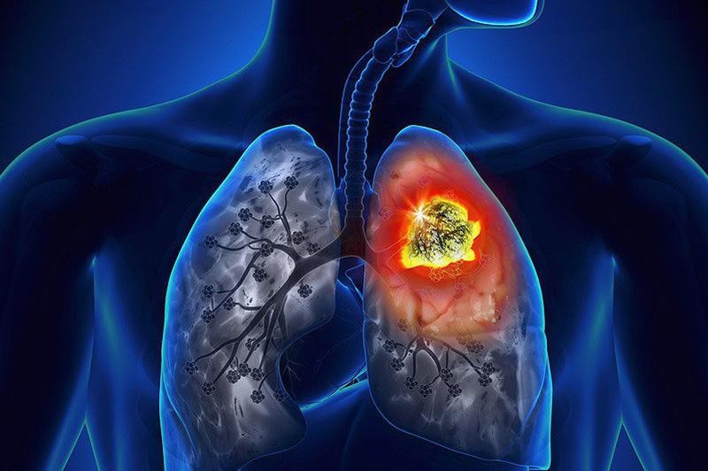 Khoảng 15% bệnh nhân phát hiện ung thư phổi ở VN còn sống sau 5 năm