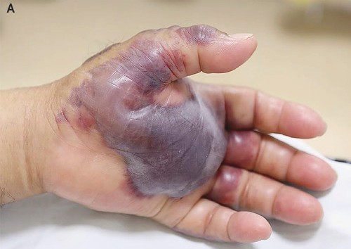 Bàn tay bị nhiễm trùng nặng do ăn hải sản sống của cụ ông Hàn Quốc. Ảnh: Asia One.