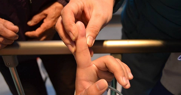 Kiến cắn vào ngón tay trái khiến bệnh nhân bị sốc phản vệ. Ảnh: BVCC
