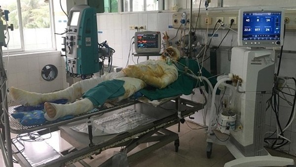 Một bệnh nhân bị bỏng đang được điều trị tại Viện Bỏng quốc gia.