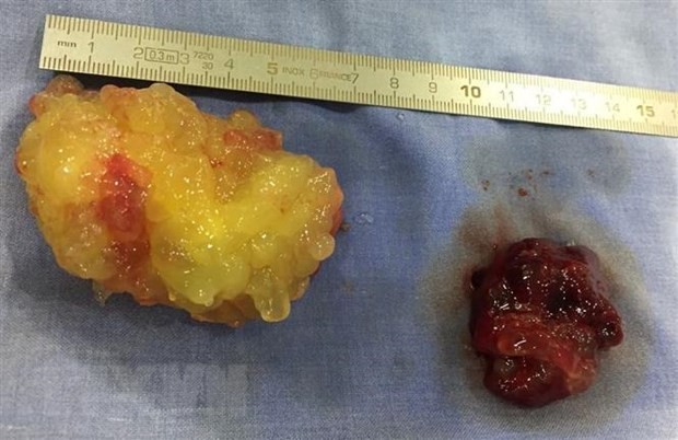 Hai khối u kích thước lớn di động trong tim của bệnh nhân. (Ảnh: Lê Xuân/TTXVN)