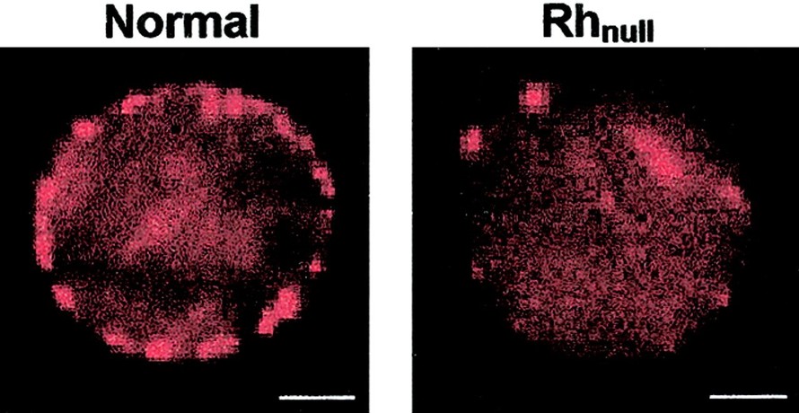 Hình ảnh so sánh giữa một tế bào hồng cầu bình thường và một tế bào hồng cầu của người nhóm máu Rh-null. Ảnh: Blood Journal