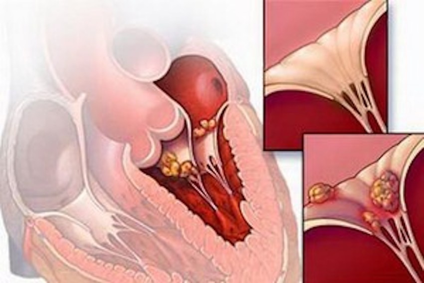 Viêm cơ tim cũng có thể do chính hệ miễn dịch tấn công gây ra