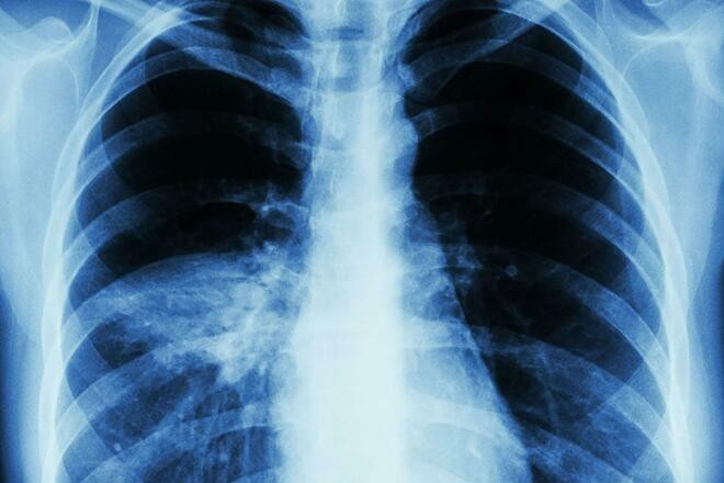 Viêm phổi là bệnh nguy hiểm, có thể dẫn tới tử vong. Ảnh: News.Virginia