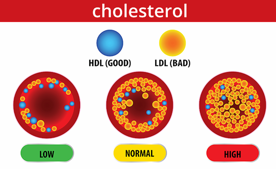 Thừa cholesterol xấu (LDL) rất nguy hiểm, dễ gây nhồi máu cơ tim, đột quỵ, tai biến,...