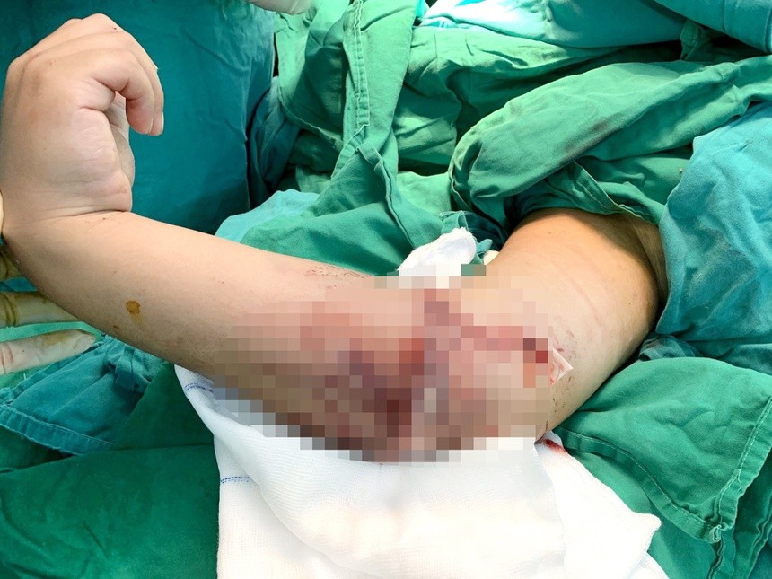 Bệnh nhân 8 tuổi đã được nối lại cẳng tay bằng vi phẫu thuật. Ảnh: BVCC. 