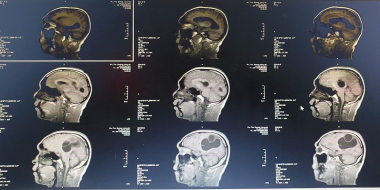 Hình ảnh CT , MRI sọ não kén sán não trước mổ - Ảnh: BVCC
