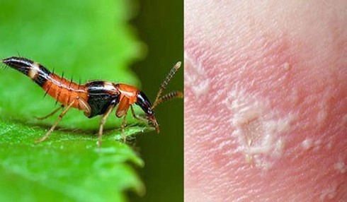 Chất độc kiến ba khoang khi tiếp xúc với da người có thể gây tổn thương da.