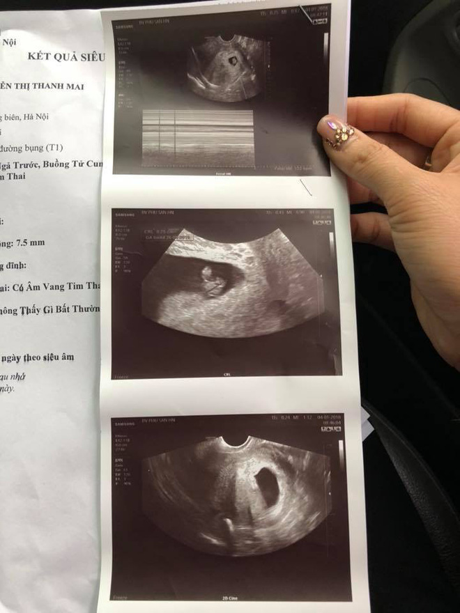 Hình ảnh siêu âm thai của của bệnh nhân tại BV Phụ sản HN