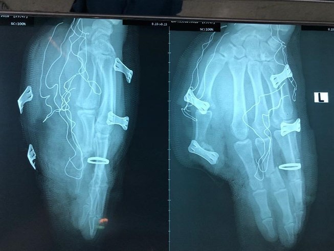 Kết quả chụp X quang cho thấy bàn tay trái anh S. bị trật hở khớp ngón và gãy xương đốt. Ảnh: Hòa Võ