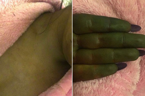 Da người và tay của Danni chuyển màu xanh sau khi bôi thuốc nhuộm. Ảnh: kennedynewsandmedia.co.uk. 