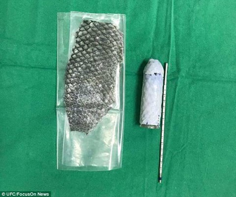 Cô gái đầu tiên trên thế giới được tái tạo âm đạo bằng da cá rô phi