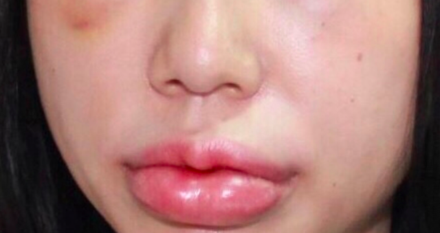 Hình ảnh bệnh nhân T.T.H bị biến chứng khi tiêm chất làm đầy (filler) ở môi, mắ