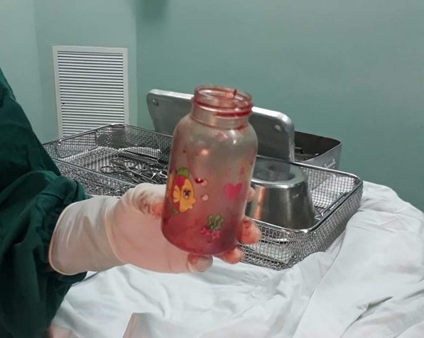 Chiếc bình nhựa sau khi phẫu thuật lấy ra từ bệnh nhân