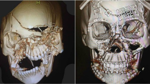 Ảnh chụp vùng mặt nữ bệnh nhân trước và sau phẫu thuật. Ảnh: Figure 1.