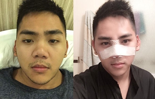 Ngọc Thắng trước và sau khi vừa phẫu thuật nâng mũi.