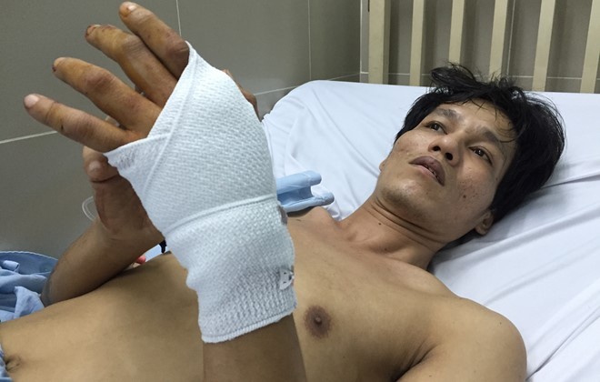 Anh Lâm sau khi phẫu thuật bàn tay bị đạn xuyên qua.