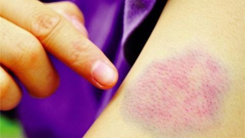 Vết bầm trên da: Dấu hiệu cảnh báo bệnh về máu nguy hiểm