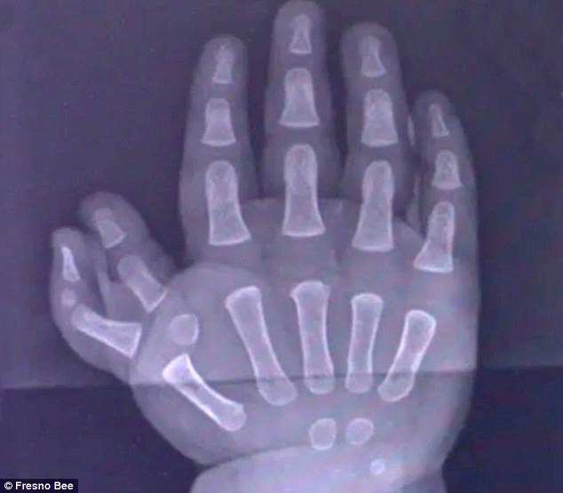 Bản chụp X-quang một bàn tay của Kyrie. Ảnh: Presno Bee.