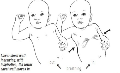 Rút lõm lồng ngực khi thở là biểu hiện thường gặp ở trẻ bị viêm phổi. 