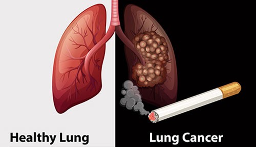 90% các trường hợp ung thư phổi liên quan đến thuốc lá.