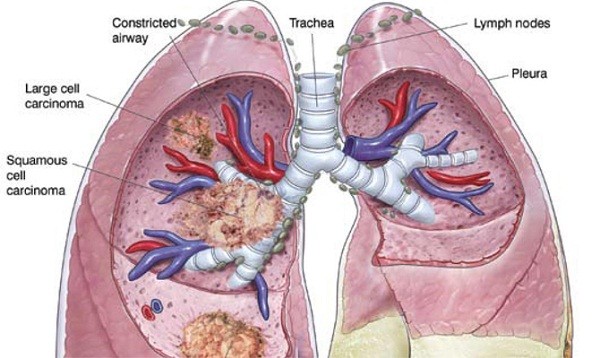 Tại Việt Nam, ung thư phổi chiếm tỉ lệ mắc và tử vong hàng đầu trong các loại ung thư ở nam giới