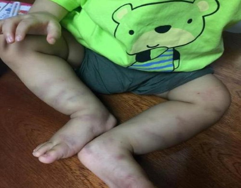 Bé trai hơn 1 tuổi được đưa vào viện với nhiều vết bầm tím trên cơ thể.