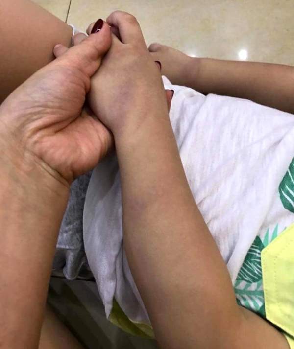 Thực hư chuyện bé trai 3 tuổi bị cô giáo đánh bầm tím chân tay