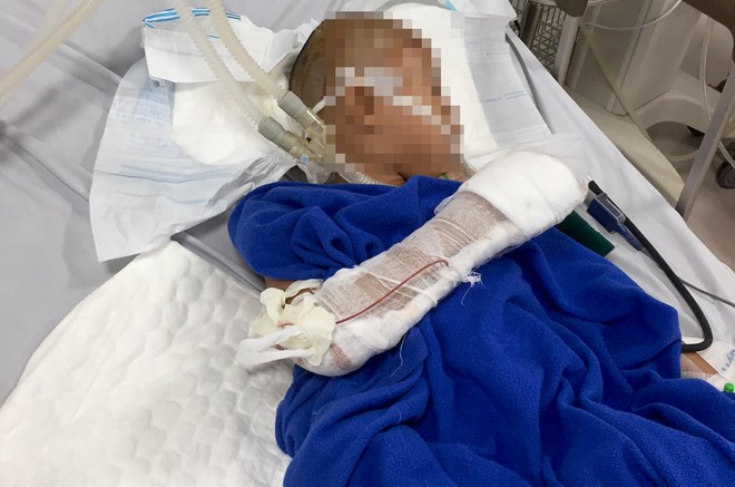 Bé trai 9 tuổi đang được điều trị tại Bệnh viện Hữu nghị Việt Nam Cuba Đồng Hới. Ảnh: Zing