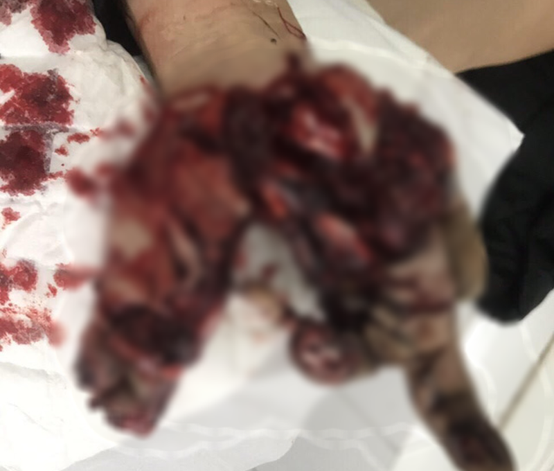 Bàn tay bị dập nát của nạn nhân. Ảnh: TTXVN