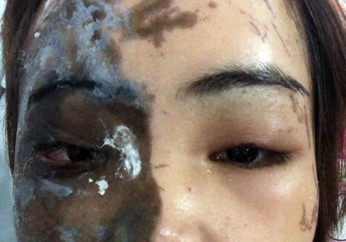 Một bên mặt của chị V. bị bỏng nặng. Ảnh: VietNamNet