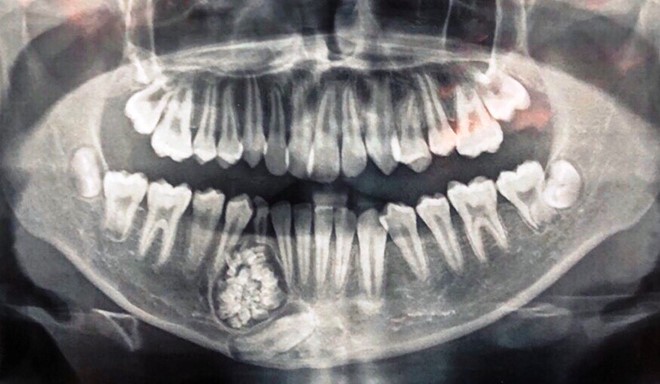 Khối u răng của bệnh nhân qua phim X-quang. Ảnh: Thanh Niên