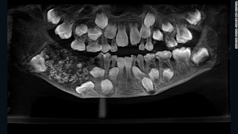 Bác sĩ phát hiện khối u chứa hơn 500 chiếc răng trong miệng cậu bé 7 tuổi