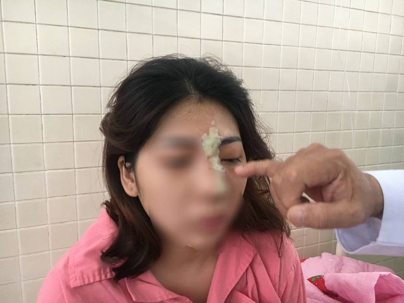 Tiêm filler tại spa, nữ bệnh nhân bị mù mắt trái