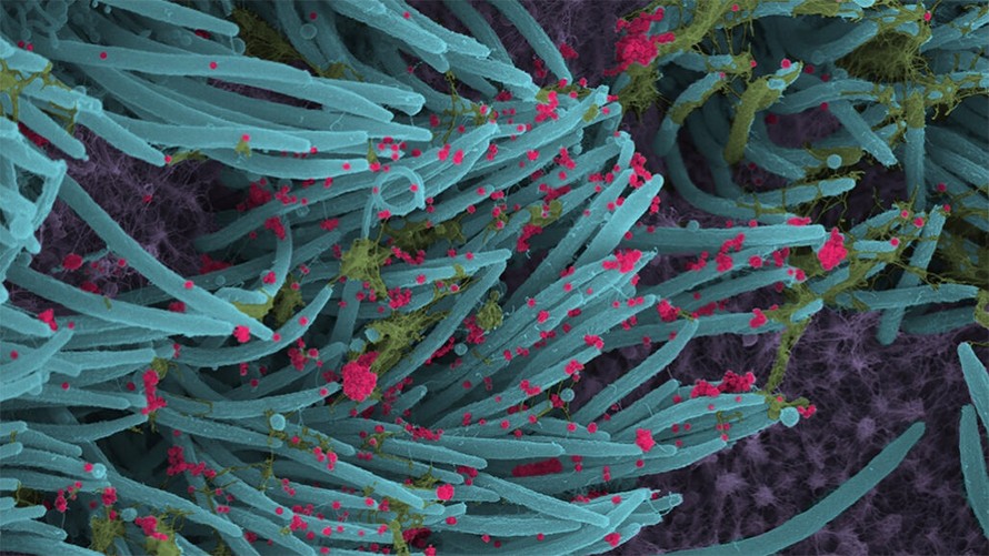 Ảnh hiển vi điện tử cho thấy các hạt virus SARS (màu đỏ) lấn át tế bào phổi của người (màu xanh lam và màu tím).
