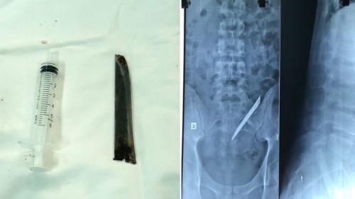 ưỡi dao Thái Lan trong cơ thể bệnh nhân trên phim X-quang và lưỡi dao khi được lấy ra. 