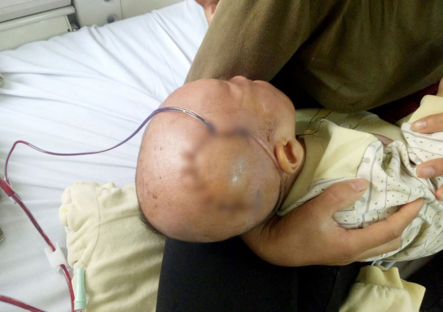 Ngã từ trên giuờng xuống, bé trai 9 tháng tuổi bị lún sọ não