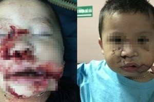 Phẫu thuật tạo hình cho bé trai 2 tuổi bị chó cắn nát mặt