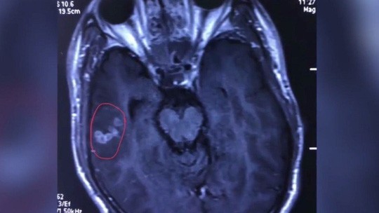 Ảnh chụp x-quang não của Liu cho thấy con sán dây dài 10 cm. Ảnh: Pear Video