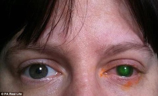 Bà Jenkins với bên mắt trái ánh lên màu xanh lục khi các bác sĩ dùng thuốc nhuộm xác định thương tổn. Toàn bộ vùng màu xanh là vết sẹo lớn gây mất thị lực - ảnh: PA Real Life