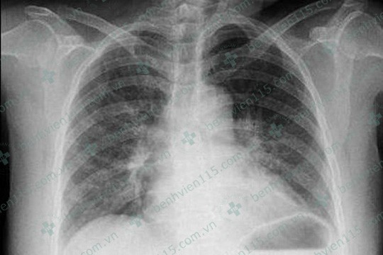 Kiểm tra X-quang phổi bệnh nhân không ghi nhận gì bất thường