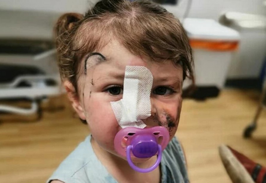 Bé gái 2 tuổi suýt mù mắt do bị chó cắn