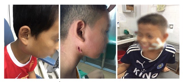 Ba bệnh nhân nhiễm "vi khuẩn ăn thịt người" được điều trị tại Bệnh viện Sản nhi Nghệ An.